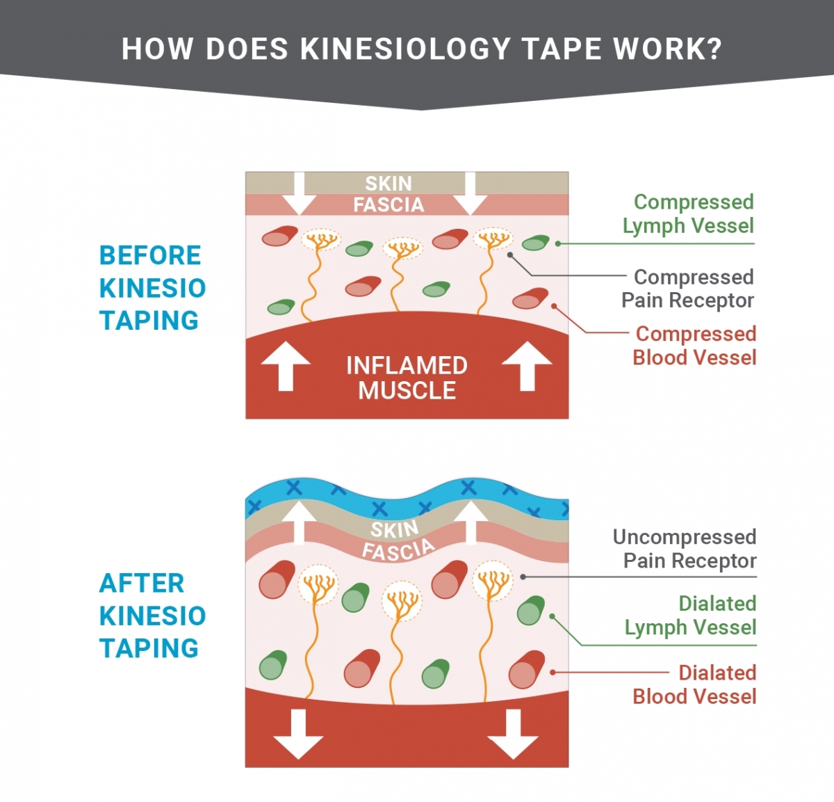 How Does Kinesiology Tape Work? Kinesiology Tape Manufacturer-CAREPROHEALTH- Kinesiology tape, elastic adhesive bandages,Would dressing,Cross Tape,Sports Rigid Tape,Elastic Adhesive Bandage,Stretched Bandage,Cohesive bandage,Underwrap Foam,Ice Hockey Tape,Band aid,Cotton Sports Tape Rayon Sports Tape,Hockey Tape,Finger Tape,PU Tape,PE Tape,Silk Tape,Paper Tape,Heel tape,Wound Dressing, Silicone Patches ( Remove Scar ),Dexcom Patches,Blister band aid,Acne Patches,Toenail Sticker,Mouth Tape,Nipple Covers,Boob Lift Tape,Face Lift Tape,Customized Patches,Assorted Band Aid,Blue Metal Detectabled Band Ai,Different Shape Band Aid,Cartoon Band Aid,Transparent Band Aid,Fabric Band Aid,Waterproof Band Aid,Nitrile Gloves,Anti-virus Gloves,Pl Surgical Gloves,Latex Surgical Gloves,Male Condoms,Female Condoms